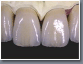 dental crown